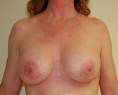 Feel Beautiful - Breast Revision San Diego 17 - After Photo